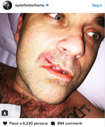 Robbie Williams ferito al volto, la moglie: “Incidente col computer”